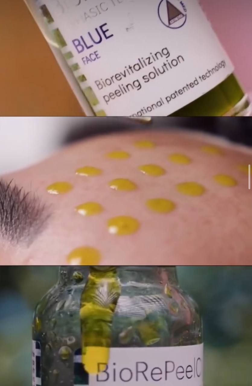 Chemical Peel